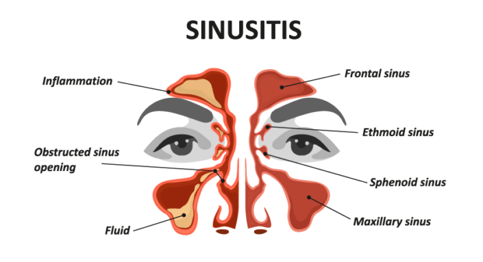 Sinus - Asheville Ear Nose & Throat - sinus surgery, balloon sinuplasty