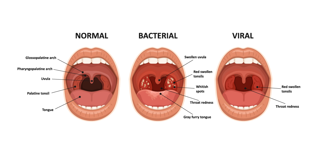 Can Tonsillitis Cause Watery Eyes